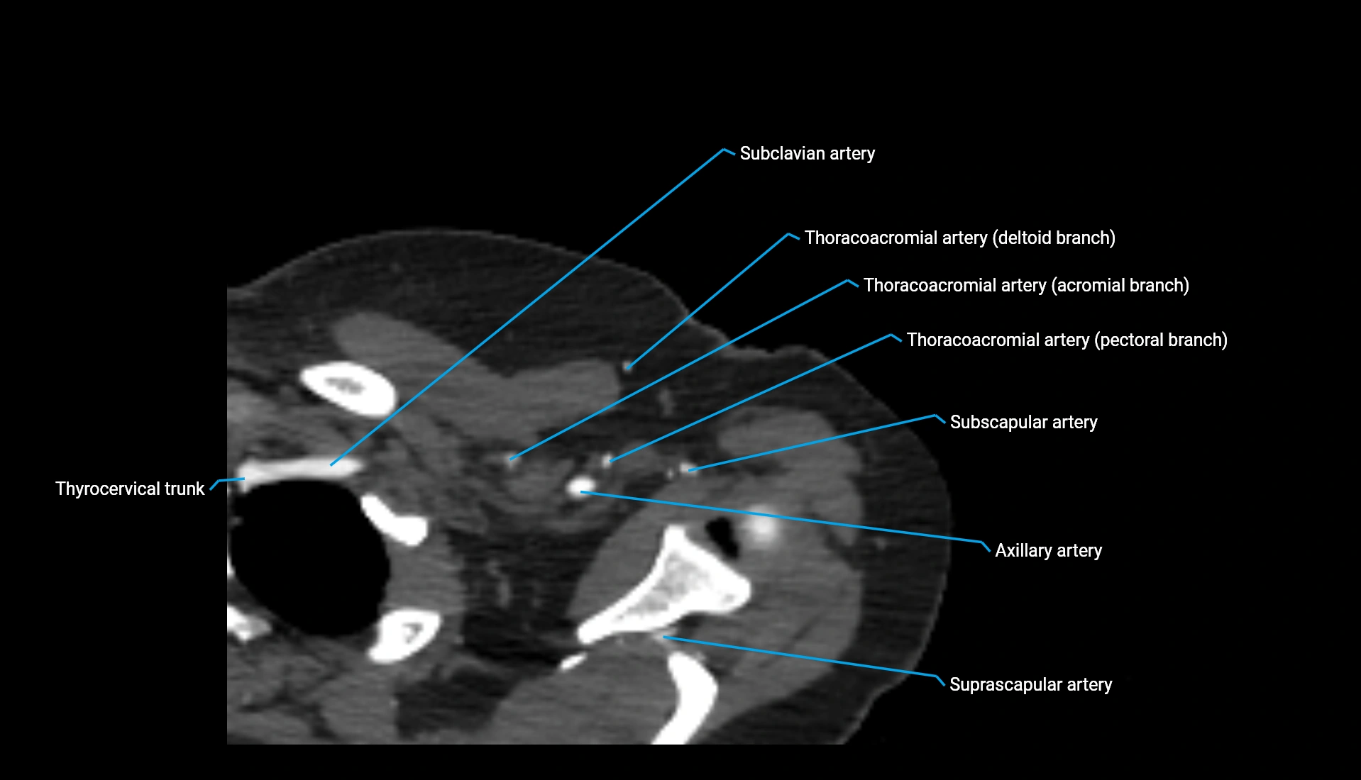 CTA upper limb axial cross sectional anatomy labelled image 333 (1).webp